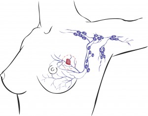 alem-do-nodulo-8-sintomas-que-podem-indicar-o-cancer-de-mama-2